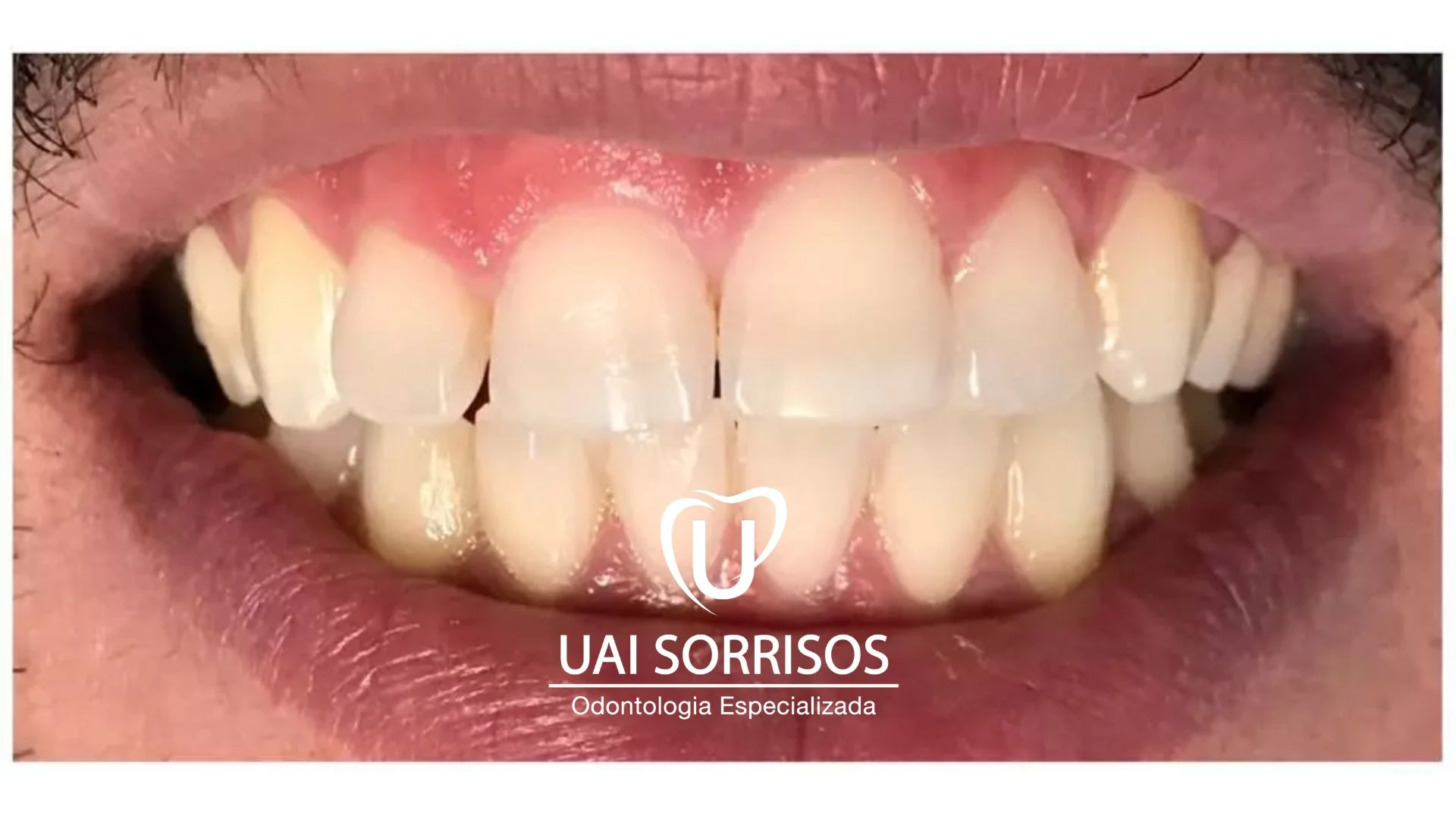 Depois Clareamento 2