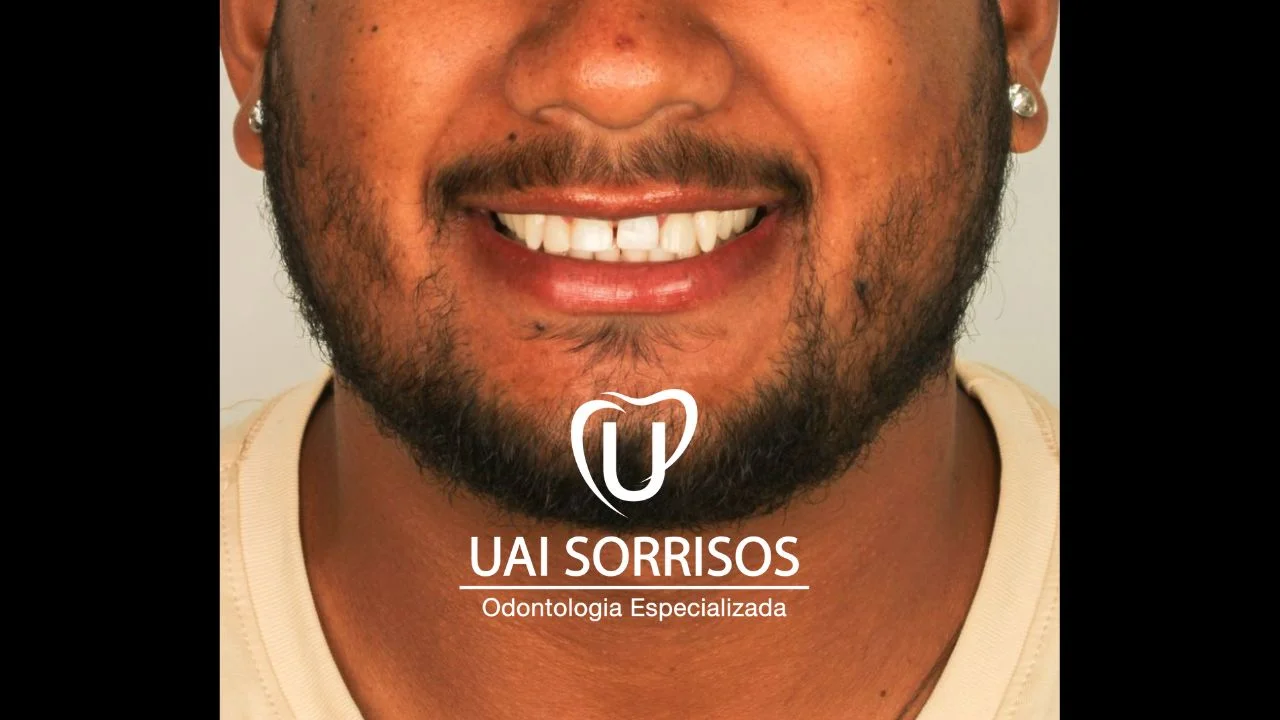 Depois Faceta Resina 1