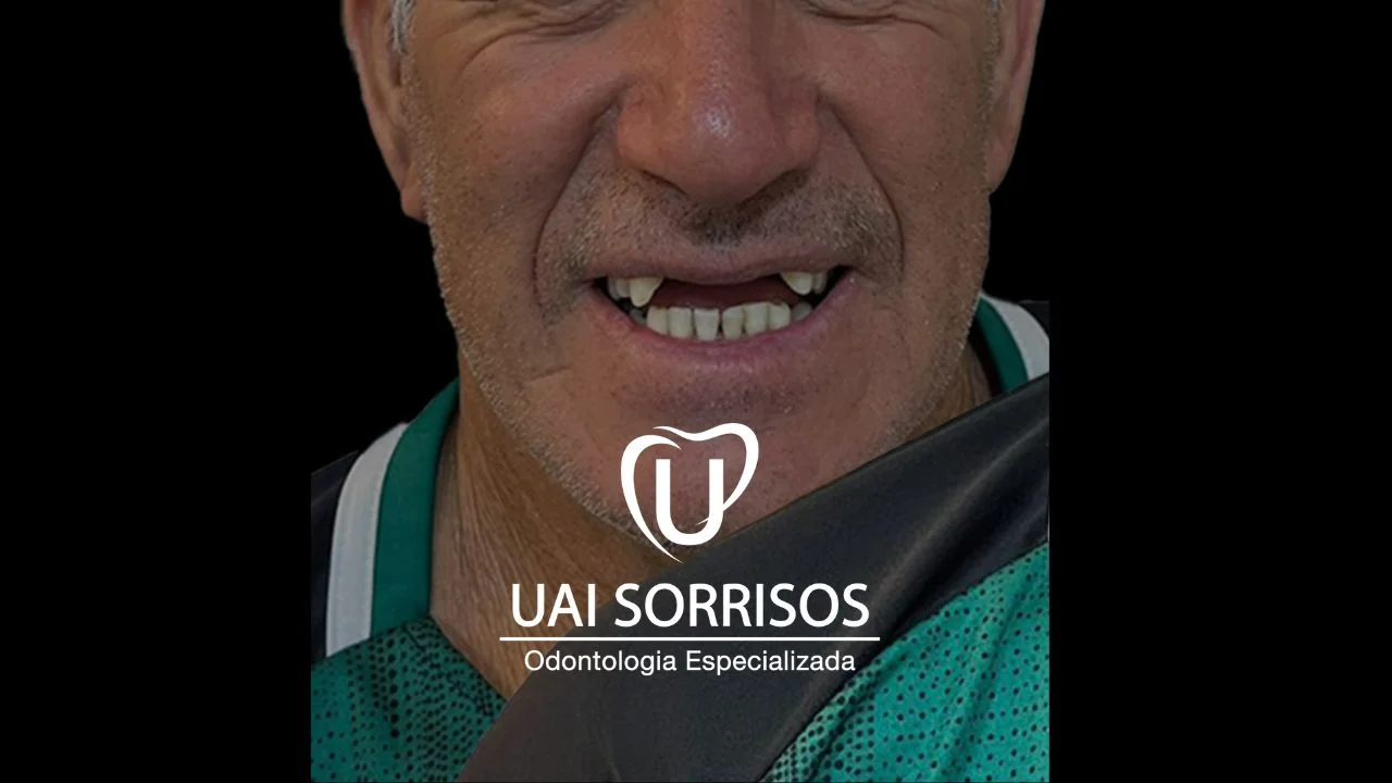 Depois Prótese Dentária 2