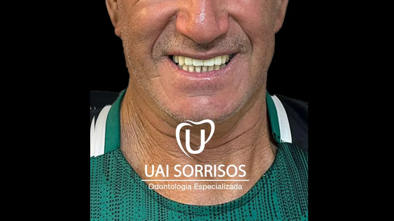 Antes Prótese Dentária 2