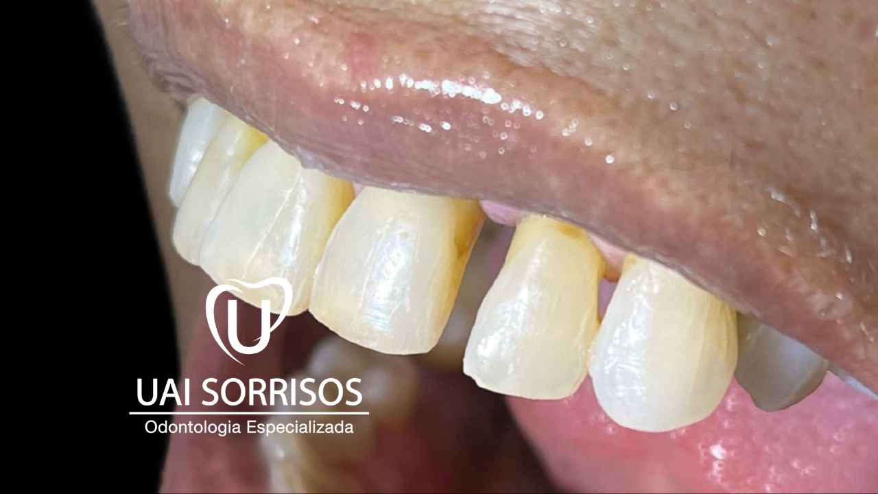 Depois Faceta Resina 2