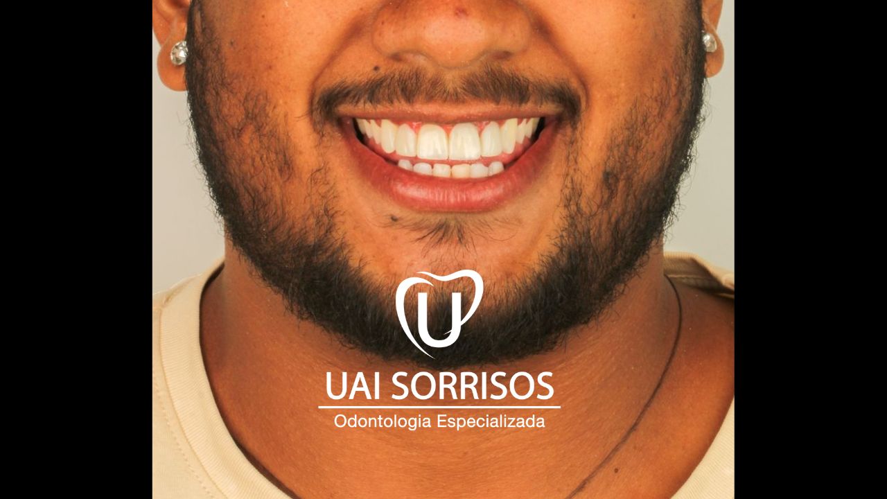 Antes Faceta Resina 1