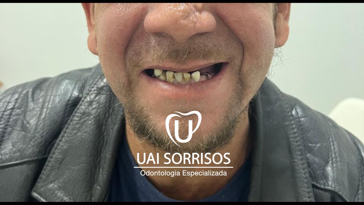 Implantes Dentários