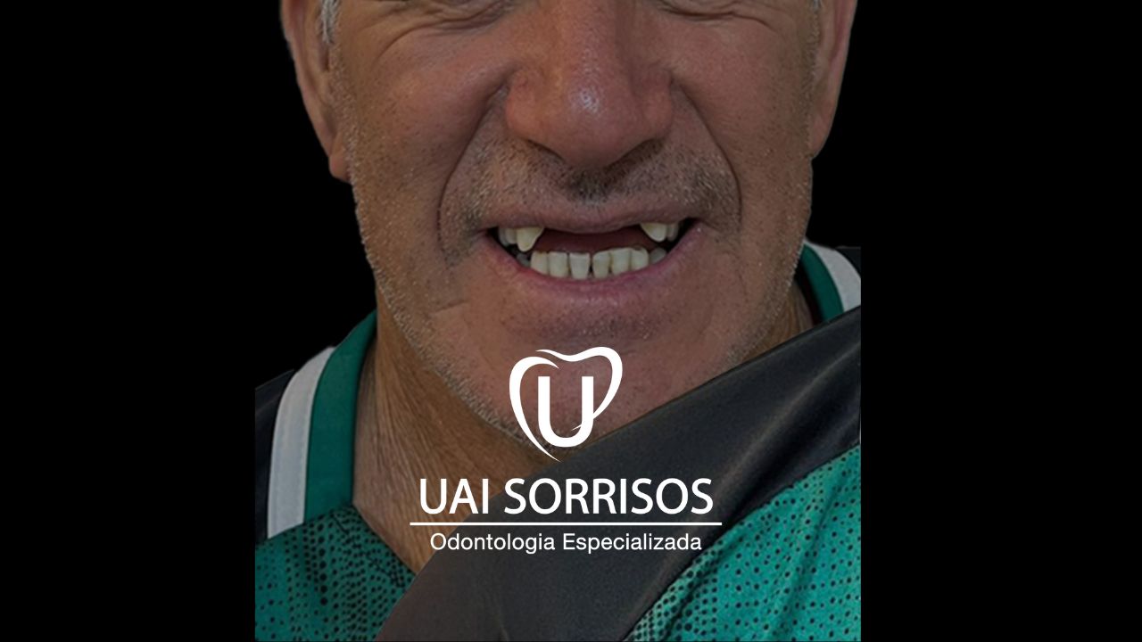Depois Implante Dentário 2