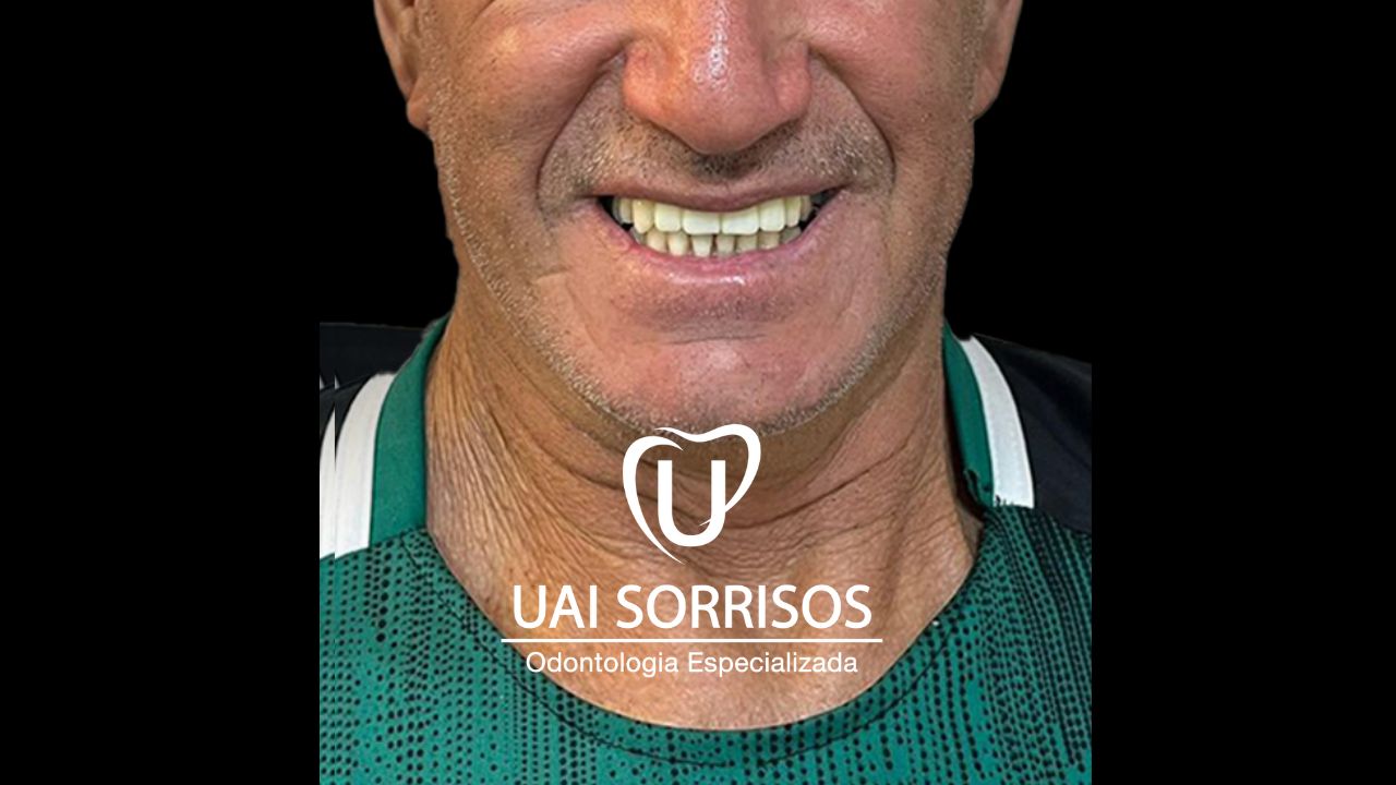 Antes Implante Dentário 2