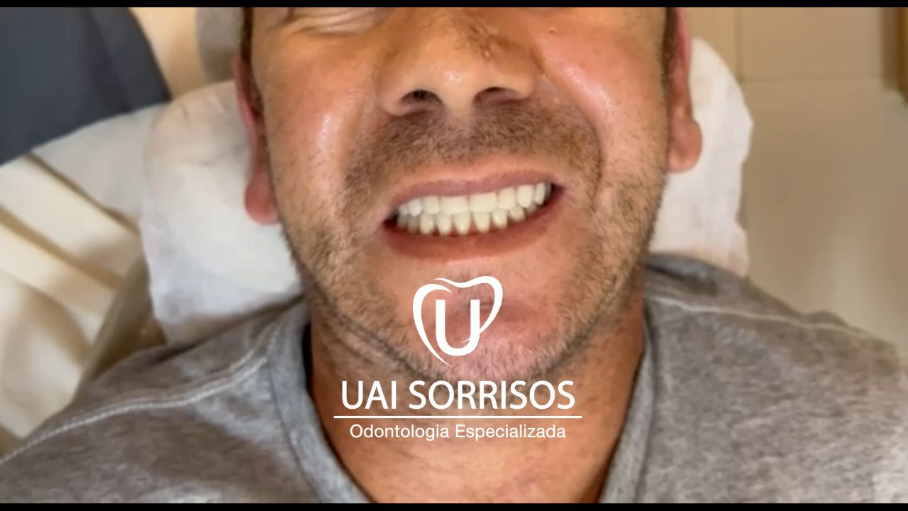 Antes Implante Dentário 1